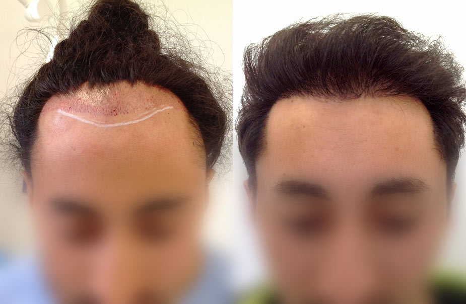 Stem Cell Hair Transplant Ik Clinics