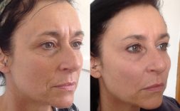 best facelift therapy