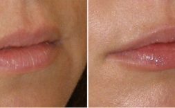 Lip Filler in london