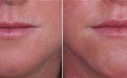 Lip Filler for women