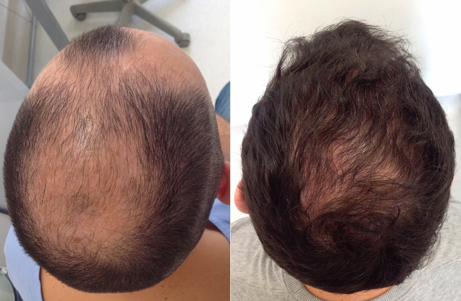 FUE hair Transplant before and after crown | IK Clinics