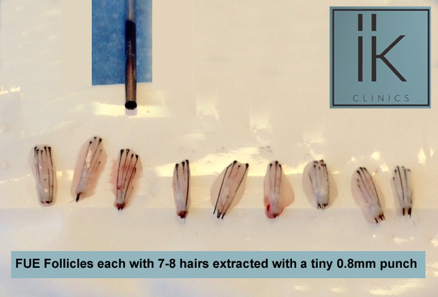 IK Clinics large-Hair-Follicles How much does a hair transplant cost?  