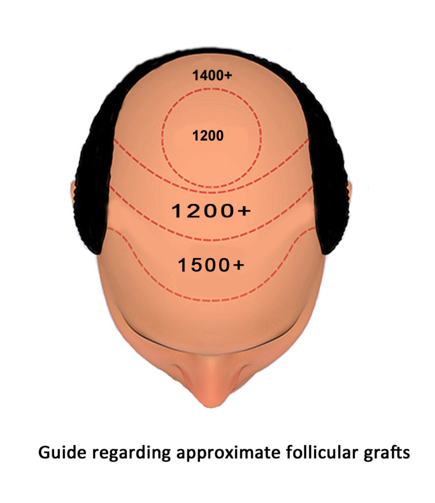 IK Clinics Guide-regarding-follicles-needed-in-hair-transplant-jpg-886x1024 How much does a hair transplant cost?  